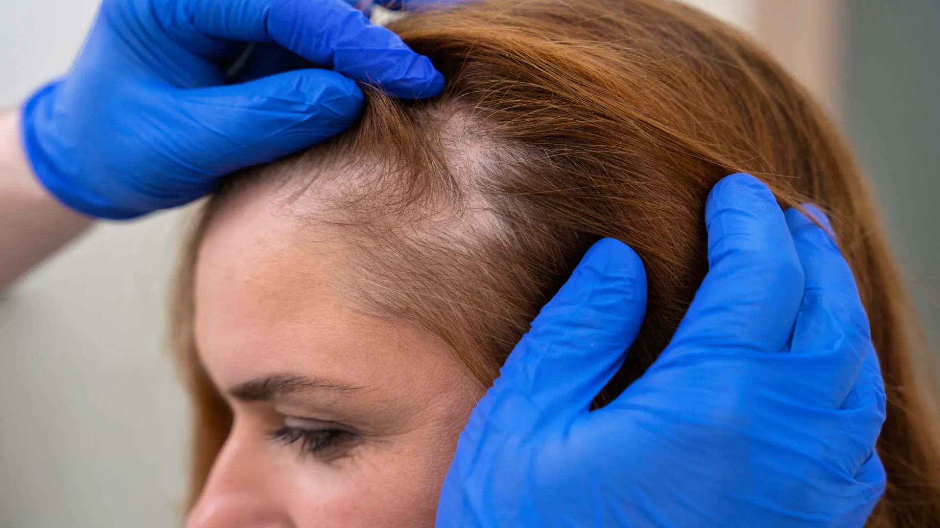 UNDERSTANDING ALOPECIA AREATA: CAUSES, SYMPTOMS, AND TREATMENT - Best ...